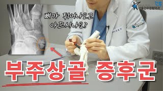 부주상골 이때는 제거해야 합니다